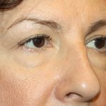 Blepharoplasty Before & After Patient #24944