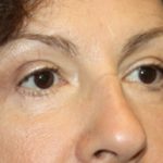 Blepharoplasty Before & After Patient #24944