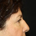 Blepharoplasty Before & After Patient #24944