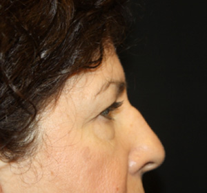 Blepharoplasty Before & After Patient #24944