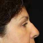 Blepharoplasty Before & After Patient #24944