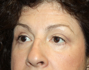 Blepharoplasty Before & After Patient #24944