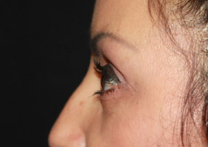 Blepharoplasty Before & After Patient #25162