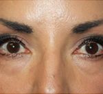 Blepharoplasty Before & After Patient #25162