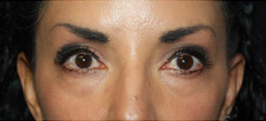 Blepharoplasty Before & After Patient #25162