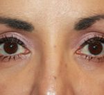 Blepharoplasty Before & After Patient #25162