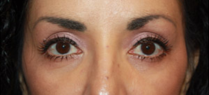 Blepharoplasty Before & After Patient #25162