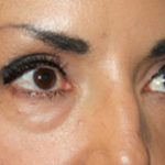 Blepharoplasty Before & After Patient #25162