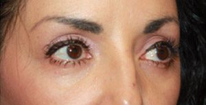 Blepharoplasty Before & After Patient #25162