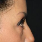 Blepharoplasty Before & After Patient #25162