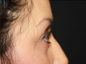 Blepharoplasty Before & After Patient #25162