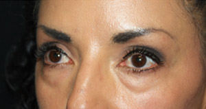 Blepharoplasty Before & After Patient #25162