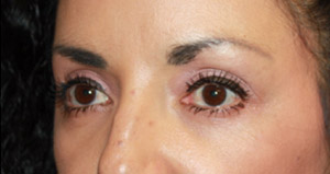 Blepharoplasty Before & After Patient #25162