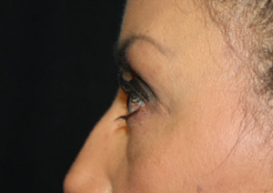 Blepharoplasty Before & After Patient #25162