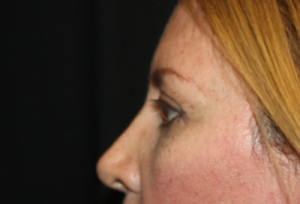 Blepharoplasty Before & After Patient #24965