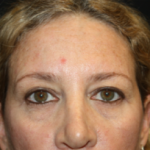 Blepharoplasty Before & After Patient #24965