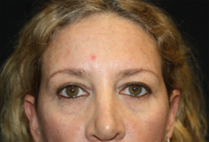 Blepharoplasty Before & After Patient #24965
