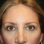 Blepharoplasty Before & After Patient #24965