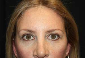 Blepharoplasty Before & After Patient #24965