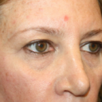 Blepharoplasty Before & After Patient #24965