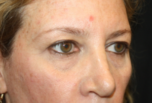 Blepharoplasty Before & After Patient #24965