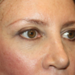 Blepharoplasty Before & After Patient #24965