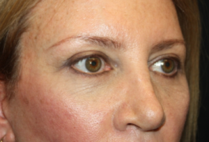 Blepharoplasty Before & After Patient #24965