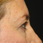 Blepharoplasty Before & After Patient #24965