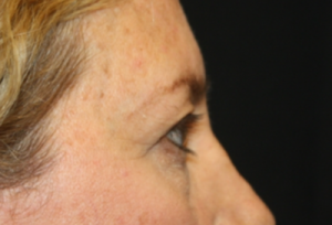 Blepharoplasty Before & After Patient #24965