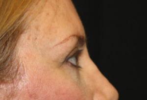 Blepharoplasty Before & After Patient #24965