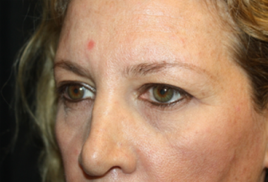 Blepharoplasty Before & After Patient #24965