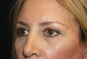 Blepharoplasty Before & After Patient #24965