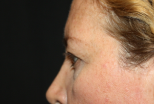 Blepharoplasty Before & After Patient #24965