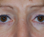 Blepharoplasty Before & After Patient #25175