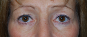 Blepharoplasty Before & After Patient #25175