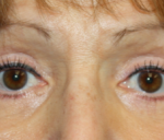 Blepharoplasty Before & After Patient #25175