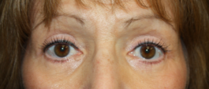 Blepharoplasty Before & After Patient #25175