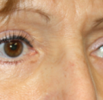 Blepharoplasty Before & After Patient #25175