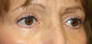 Blepharoplasty Before & After Patient #25175