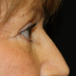 Blepharoplasty Before & After Patient #25175