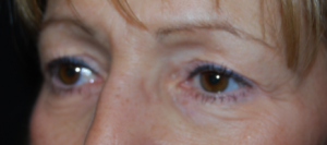 Blepharoplasty Before & After Patient #25175