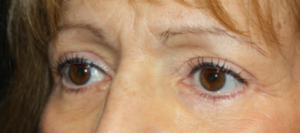 Blepharoplasty Before & After Patient #25175