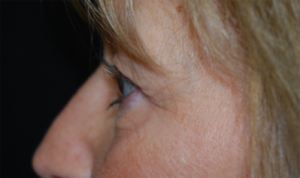 Blepharoplasty Before & After Patient #25175