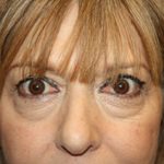 Blepharoplasty Before & After Patient #25176