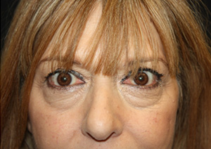 Blepharoplasty Before & After Patient #25176
