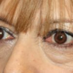 Blepharoplasty Before & After Patient #25176