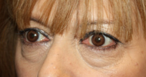 Blepharoplasty Before & After Patient #25176