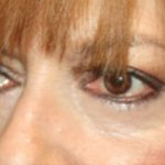 Blepharoplasty Before & After Patient #25176