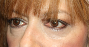 Blepharoplasty Before & After Patient #25176