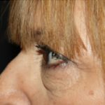 Blepharoplasty Before & After Patient #25176